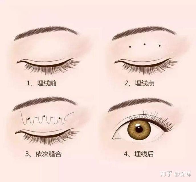 最新雙眼皮技術(shù)，無(wú)需開(kāi)刀，遠(yuǎn)離埋線，美麗新選擇