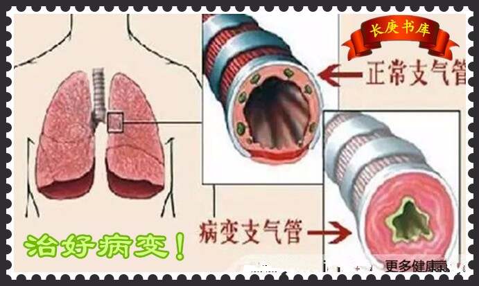 支氣管擴張最新治療方案，探索與進步